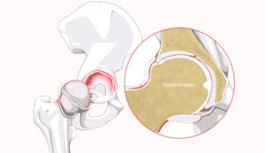 torn labrum diagram